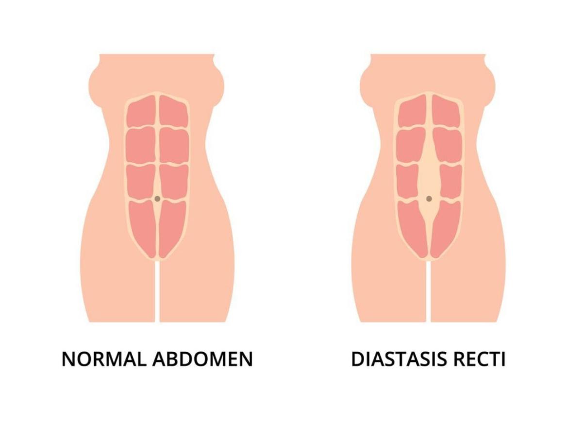 Ilustrație diastaza abdominală